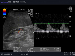 Ultrazvok ledvic - kronična parenhimska okvara ledvice, povišan rezistenčni indeks (RI)